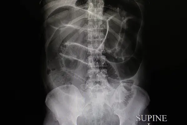 Intestinal Obstruction Ray Scan — Stock Photo, Image