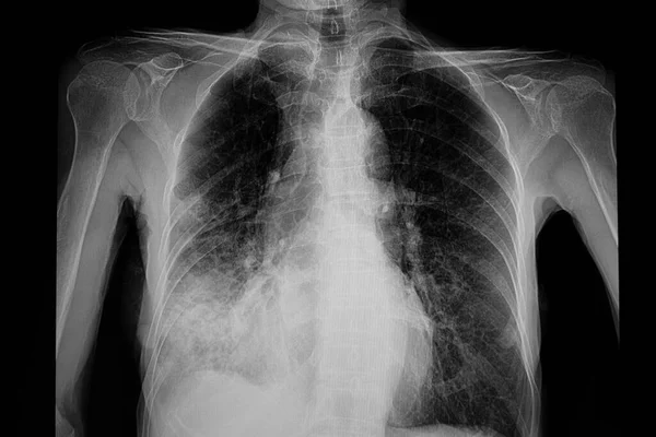 Zapalenie Płuc Prawe Dolne Płuco Skan Obrazu — Zdjęcie stockowe