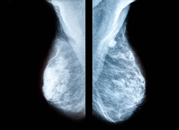 Screening Breast Cancer Radiology — Stock Photo, Image