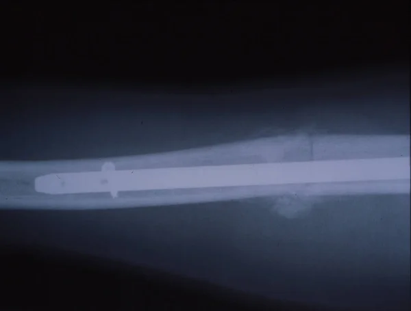 Kazadan Sonra Çivilenmiş Bir Kemiğin Röntgeni — Stok fotoğraf