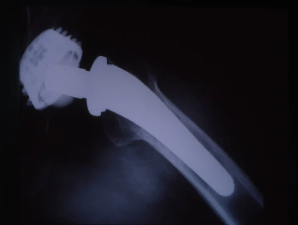 人工髋关节在人大腿X光图像中的应用 — 图库照片