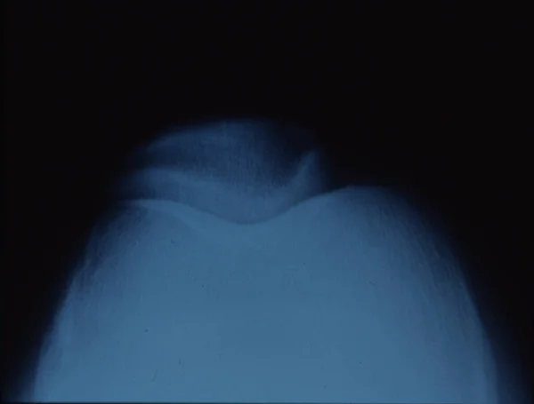 膝盖骨与关节的X线像图 — 图库照片