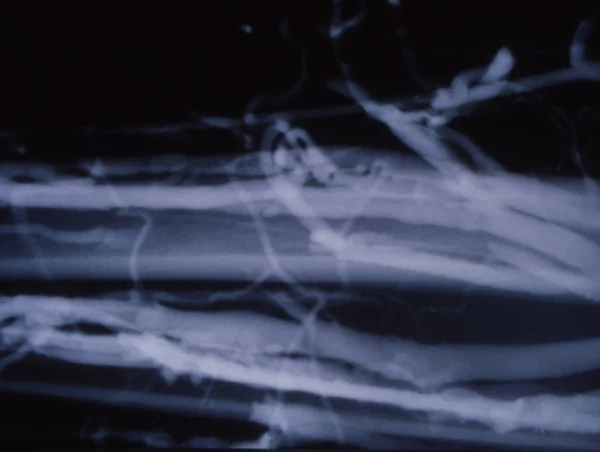 X線における静脈瘤としての脚静脈 — ストック写真