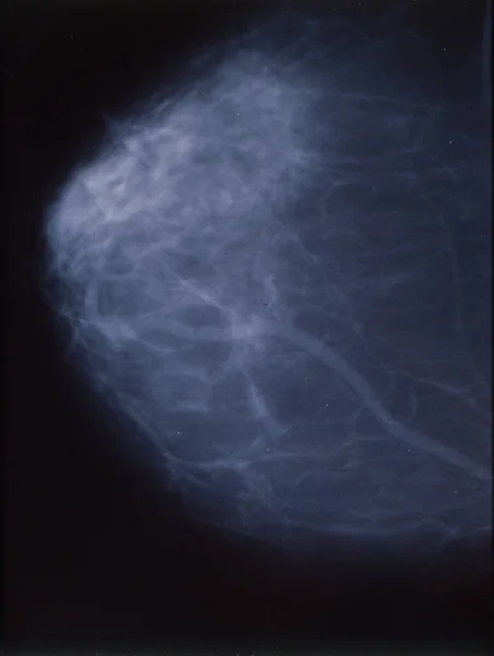 Ray Als Mammografie Van Vrouwelijke Borst — Stockfoto