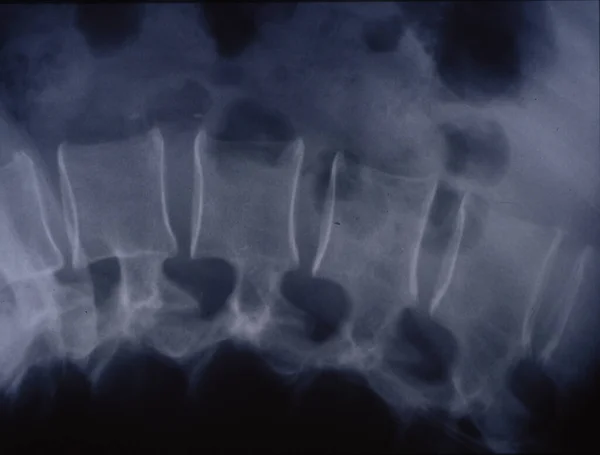 Tıbbi Teşhis Için Omurganın Röntgen Görüntüsü — Stok fotoğraf