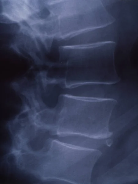 Tıbbi Teşhis Için Omurganın Röntgen Görüntüsü — Stok fotoğraf