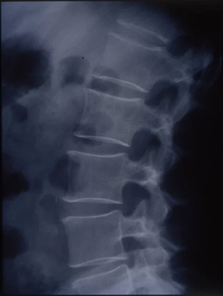 Röntgenbild Der Wirbelsäule Zur Medizinischen Diagnose — Stockfoto