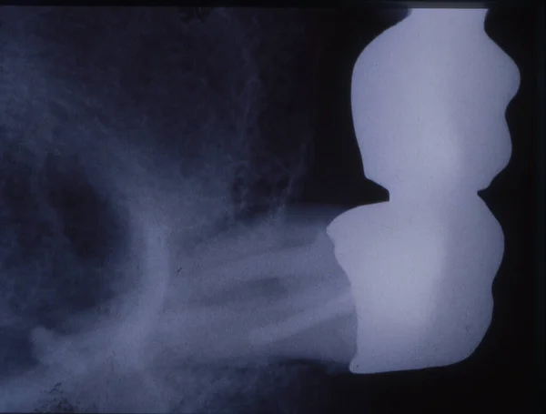 Röntgenbild Von Zähnen Mit Füllungen Und Brücken — Stockfoto