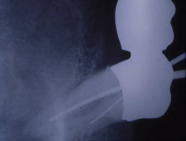 Рентгеновское Изображение Зубов Пломбами Мостами — стоковое фото