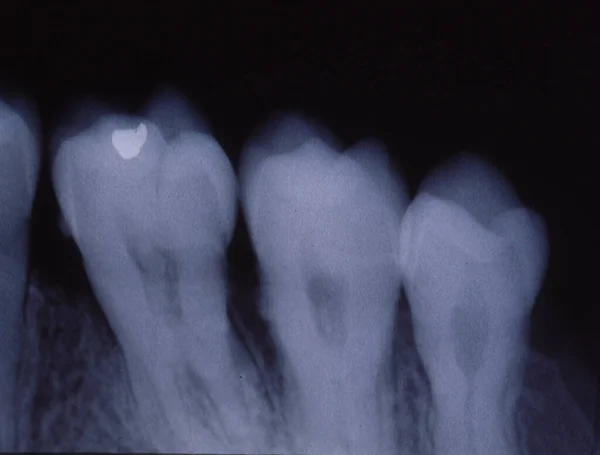 Röntgenbild Von Zähnen Mit Füllungen Und Brücken — Stockfoto