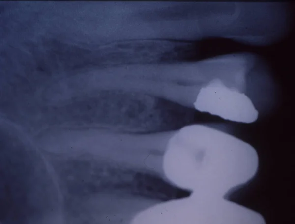 Image Radiographique Des Dents Avec Obturations Ponts — Photo