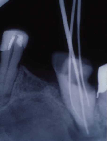 Dolgu Köprülü Dişlerin Ray Görüntüsü — Stok fotoğraf
