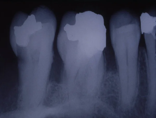 有填充物和桥的牙齿的X光图像 — 图库照片