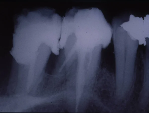 充填剤とブリッジと歯のX線画像 — ストック写真