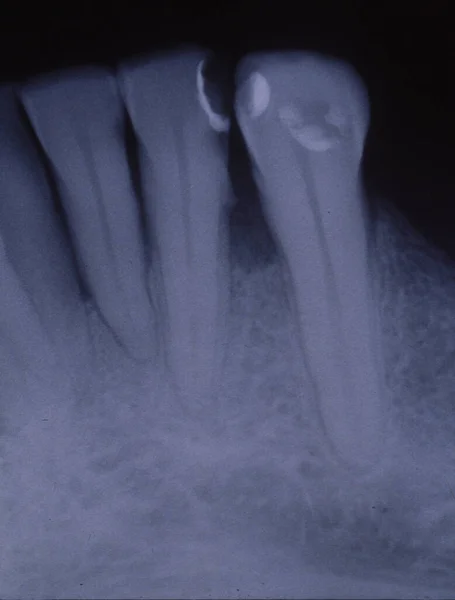 Röntgenbild Tänder Med Fyllningar Och Broar — Stockfoto