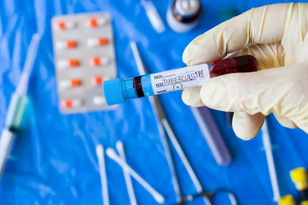 Tuberkulose Blutteströhrchen Labor Und Chemische Instrumente Diagnosen Und Forschung — Stockfoto