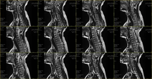 Set Sagittal Mri Scans Neck Area Caucasian Years Old Male — Stock Photo, Image