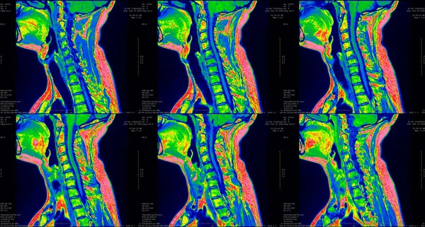 C6-C7 segmentinin çift taraflı paramedial ekstrüzyonu olan beyaz 34 yaşındaki bir erkeğin boyun bölgesinin 6 sagital yeşil MRI taramasını yapın.