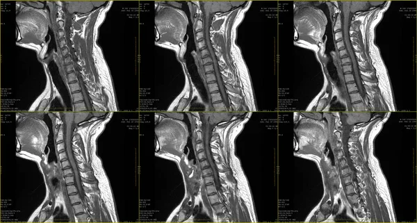 Sagittale Kernspintomographien Des Halsbereichs Eines Jährigen Kaukasischen Mannes Mit Beidseitiger — Stockfoto