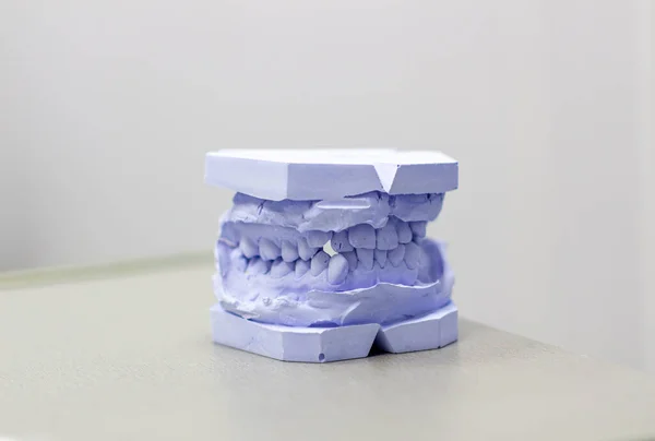 Gipsgjutning Tänder Från Gips Hos Tandläkaren — Stockfoto