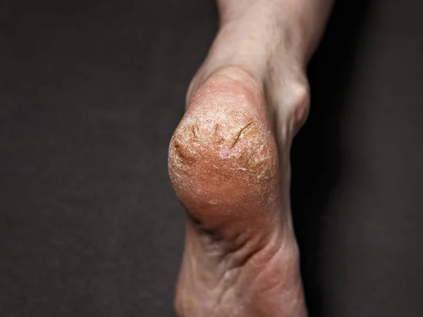 人的脚后跟 皮肤上有疼痛的裂缝 — 图库照片