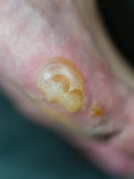 Ampolla Grande Pie Pompholyx Eczema —  Fotos de Stock