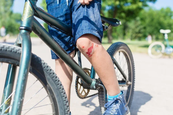 Boy Wearing Shorts Bike Bloodstained Scratch Knee — Foto de Stock