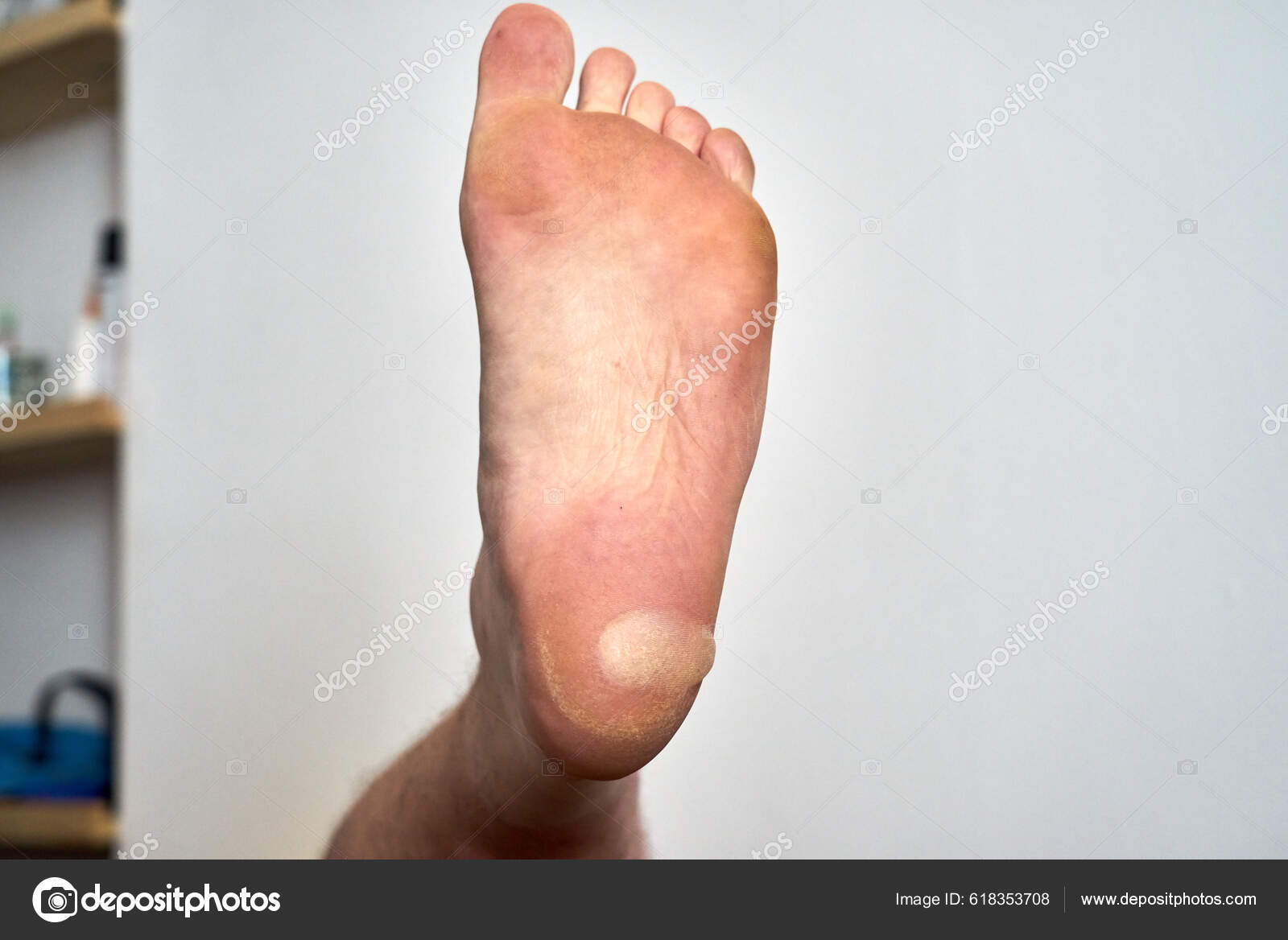 Friction Blister On Back Of Heel Large Blister Heel Foot — Stock