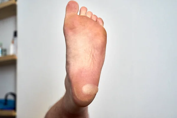A large blister on the heel of a foot