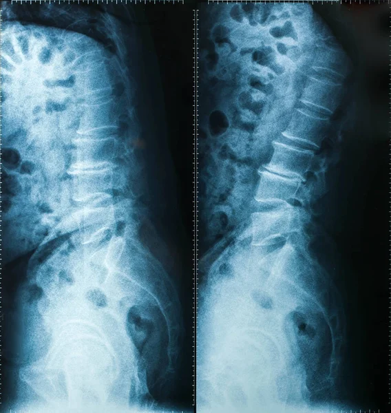 Ray Image View Neck Men Medical Diagnosis — Stock Photo, Image