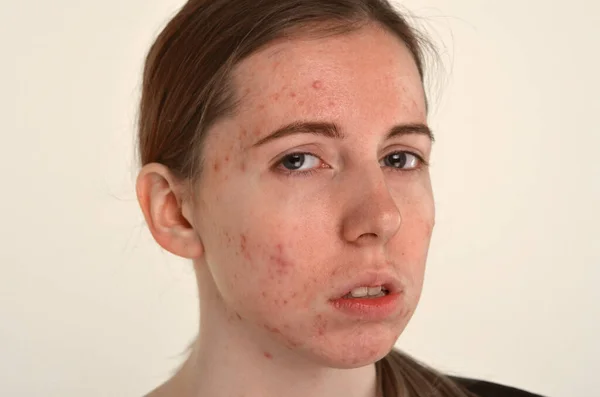 問題のある肌を持つ美しい若い女の子 にきび問題の概念 — ストック写真