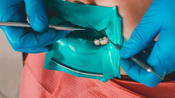 Dentista Instala Uma Barragem Borracha Tratamento Dentário Estéril Equipamentos Modernos — Fotografia de Stock