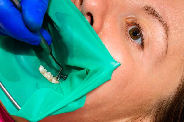 Tratamento Dente Mascar Dentista Colocou Uma Represa Borracha Usa Ferramentas — Fotografia de Stock