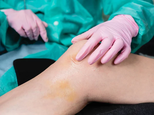 Doktorun Elleri Hastanın Bacağındaki Çürüğe Tıbbi Merhem Sürüyor Ağrı Hematom — Stok fotoğraf