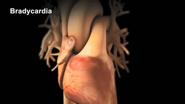 Bradycardia Означает Медленное Сердцебиение Частота Сердечных Сокращений Менее Ударов Минуту — стоковое фото