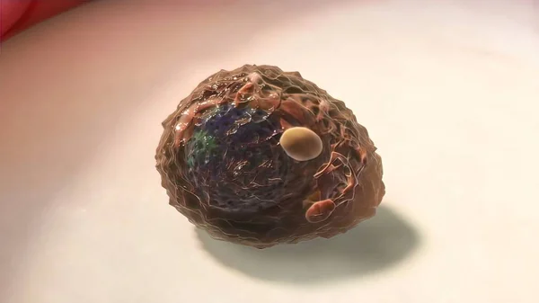Πολλαπλό Μυέλωμα Ένας Τύπος Καρκίνου Που Αποτελείται Από Λευκά Αιμοσφαίρια — Φωτογραφία Αρχείου