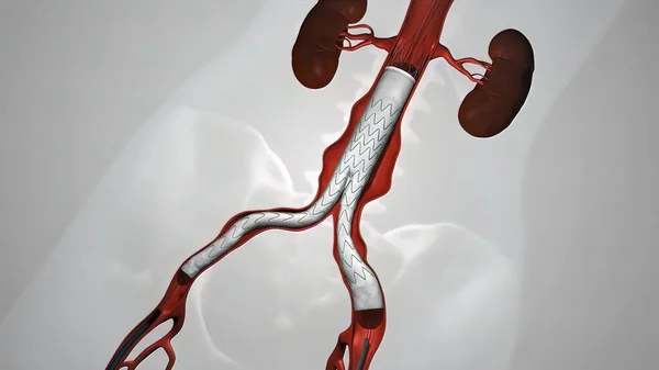 静脉支架气球血管成形术 — 图库照片