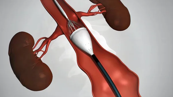 Balloon Angioplasty Procedure Stent Vein — Stock Photo, Image