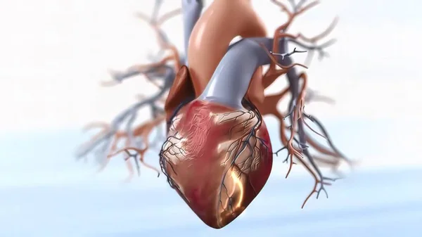 急性冠状动脉综合征3D医学 — 图库照片