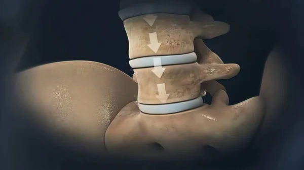 椎骨に対する椎間板関節炎の影響の圧縮 — ストック写真