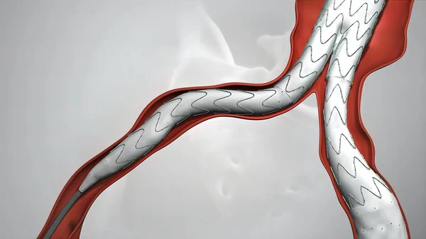 静脉支架气球血管成形术 — 图库照片
