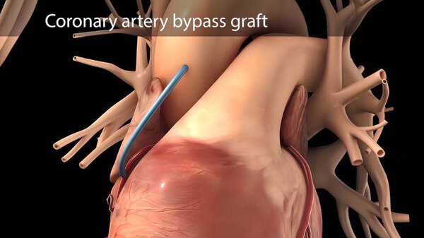 "Coronary artery bypass surgery is done using a healthy blood vessel called a graft."