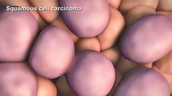 Διαίρεση Και Ανάπτυξη Καρκινικών Κυττάρων — Φωτογραφία Αρχείου