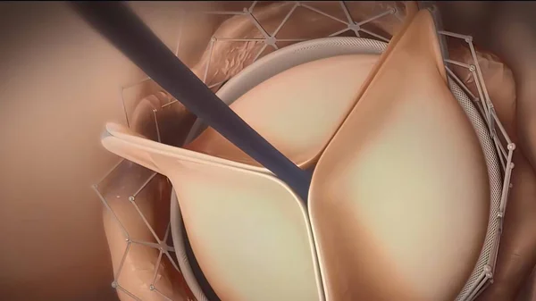 Viene Inserita Una Valvola Cardiaca Artificiale Invece Una Valvola Cardiaca — Foto Stock