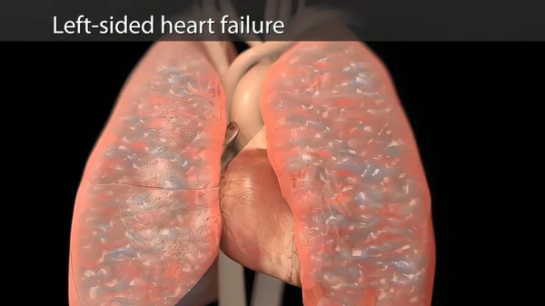 Иллюстрация Congestive Heart Failure — стоковое фото