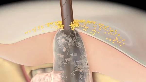 Entzündliche Akne Tritt Auf Wenn Bakterien Verstopfte Oder Verschlossene Poren — Stockfoto
