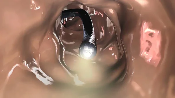 Biopsia Colonoscopia Del Tracto Gastrointestinal Pacientes — Foto de Stock