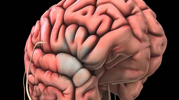 Schade Aan Hersenen Veroorzaakt Hersenbloeding — Stockfoto