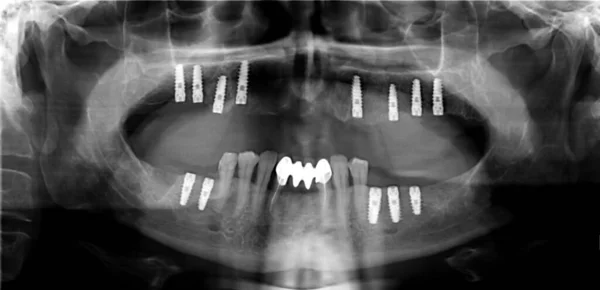 Panoramische Tanden Geschoten Met Implantaten — Stockfoto