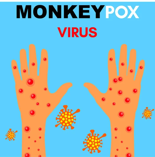 Monkeypokkenvirus Illustratie Vector Van Handen Met Monkeypokken Monkeypokkenvirus Uitbraak Pandemisch — Stockfoto